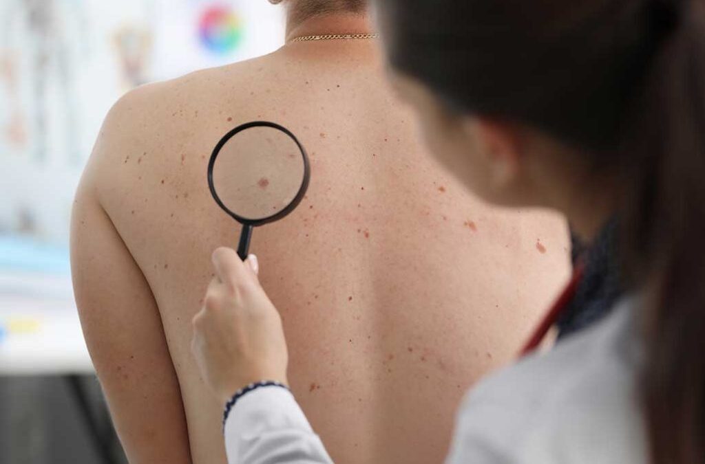 Día Mundial del Melanoma: recalcan importancia de controlar los lunares
