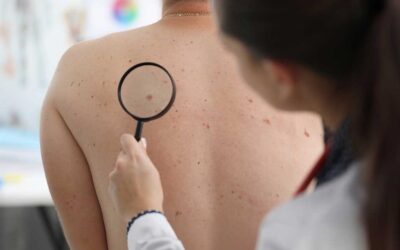 Día Mundial del Melanoma: recalcan importancia de controlar los lunares