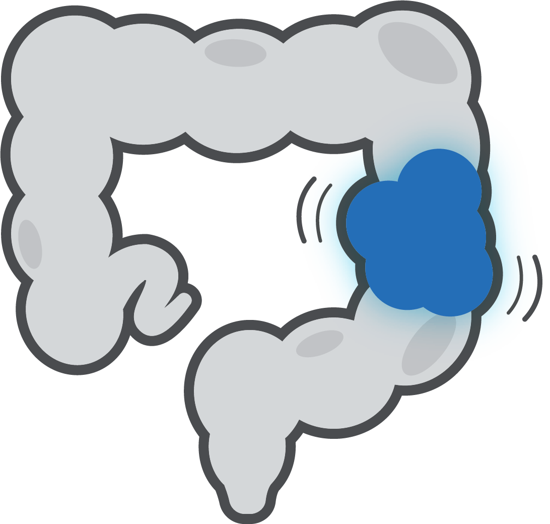 Colon Cancer