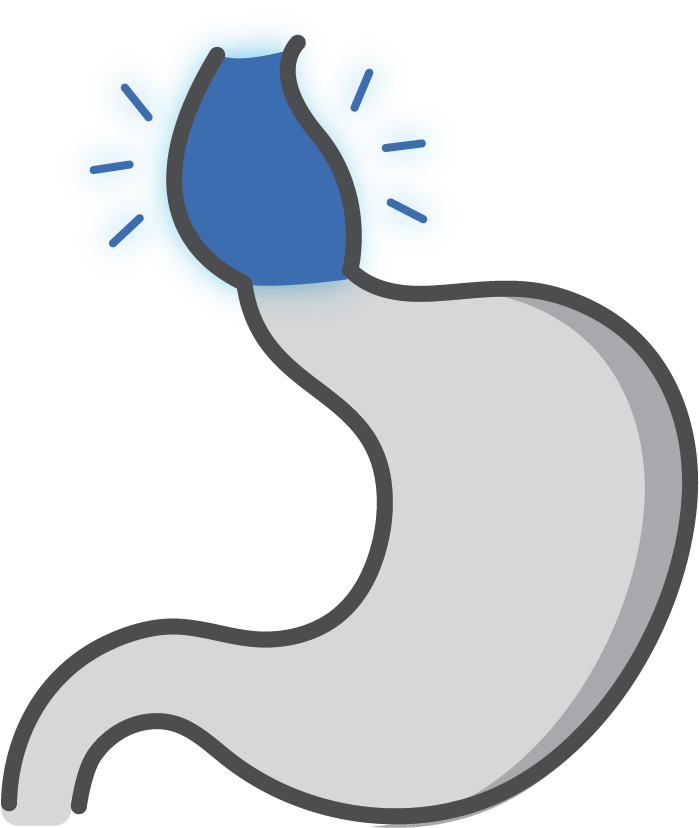 Achalasia