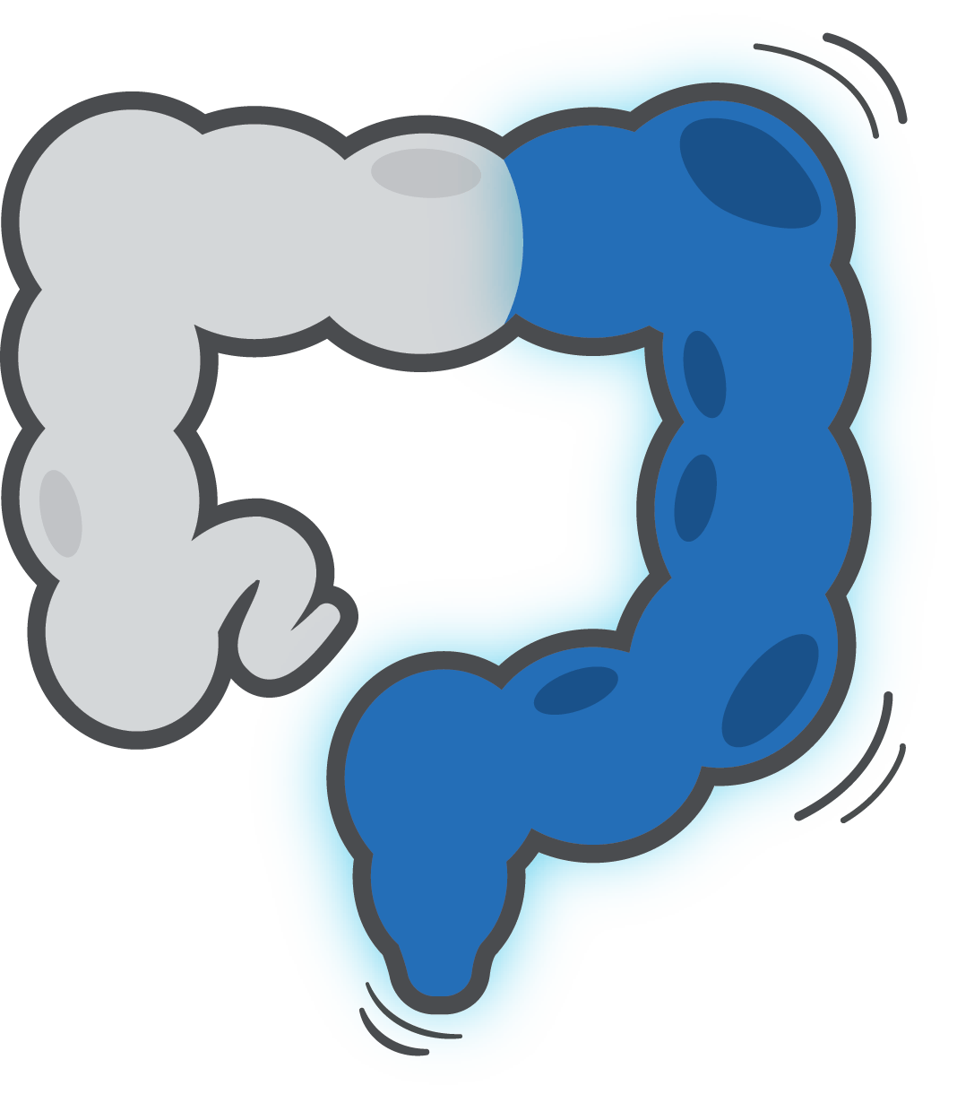 Ulcerative Colitis