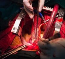 Bentall's Operation In The Ascending Aortic Aneurysm repair