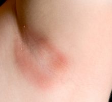 armpit with red rash caused by yeast infection is typical of summer skin problems