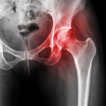 X-ray of hip with arthritis shown in red could benefit from regenerative therapies