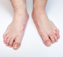 severe athlete's foot rash