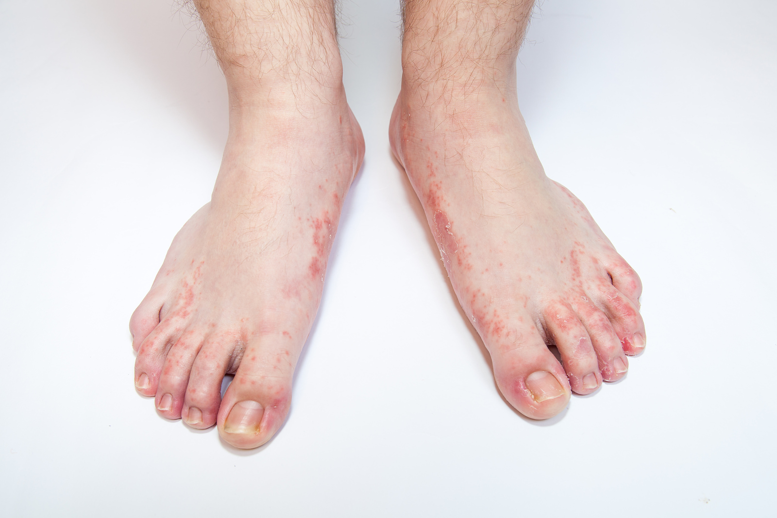 Does Diabetes Cause Itchy Feet