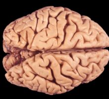 brain shrinkage-cortical atrophy