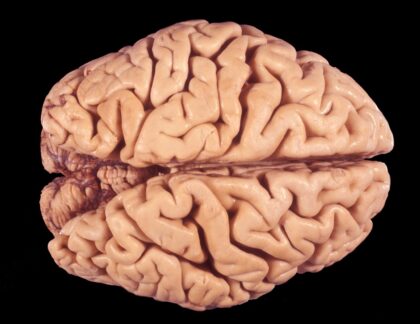 brain shrinkage-cortical atrophy