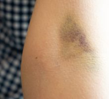bruise on arm of person subject to easy bruising
