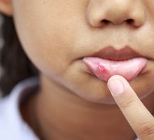 child shows painful canker sore on lip