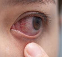closeup of red irritated eye