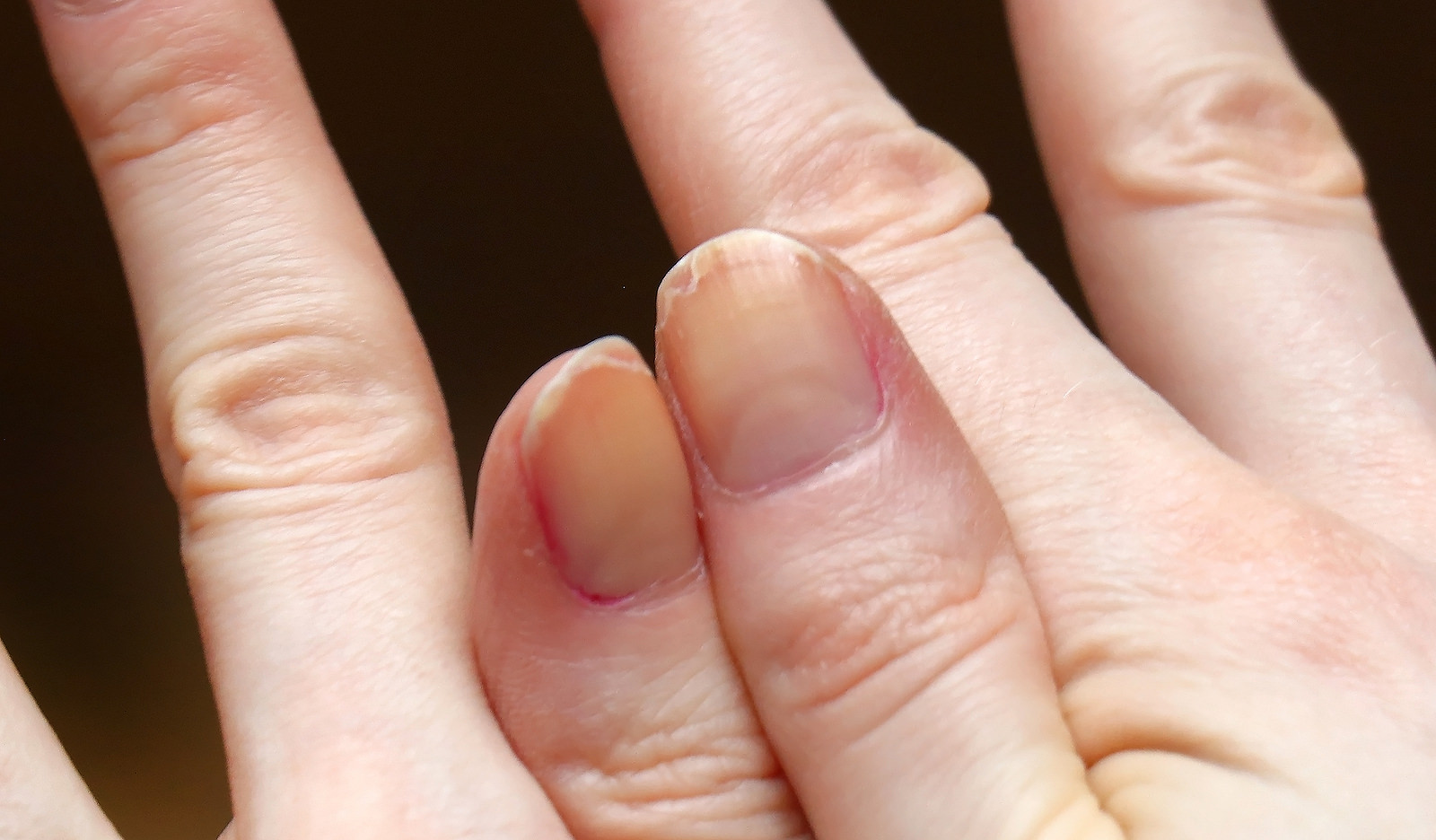 Cracked Fingernails With Brittle Splitting And Peeling Nails - The People's  Pharmacy