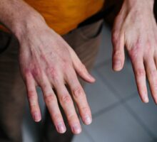 Dry, rough, red hands