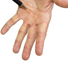 Male hand shows Dupuytren's contracture