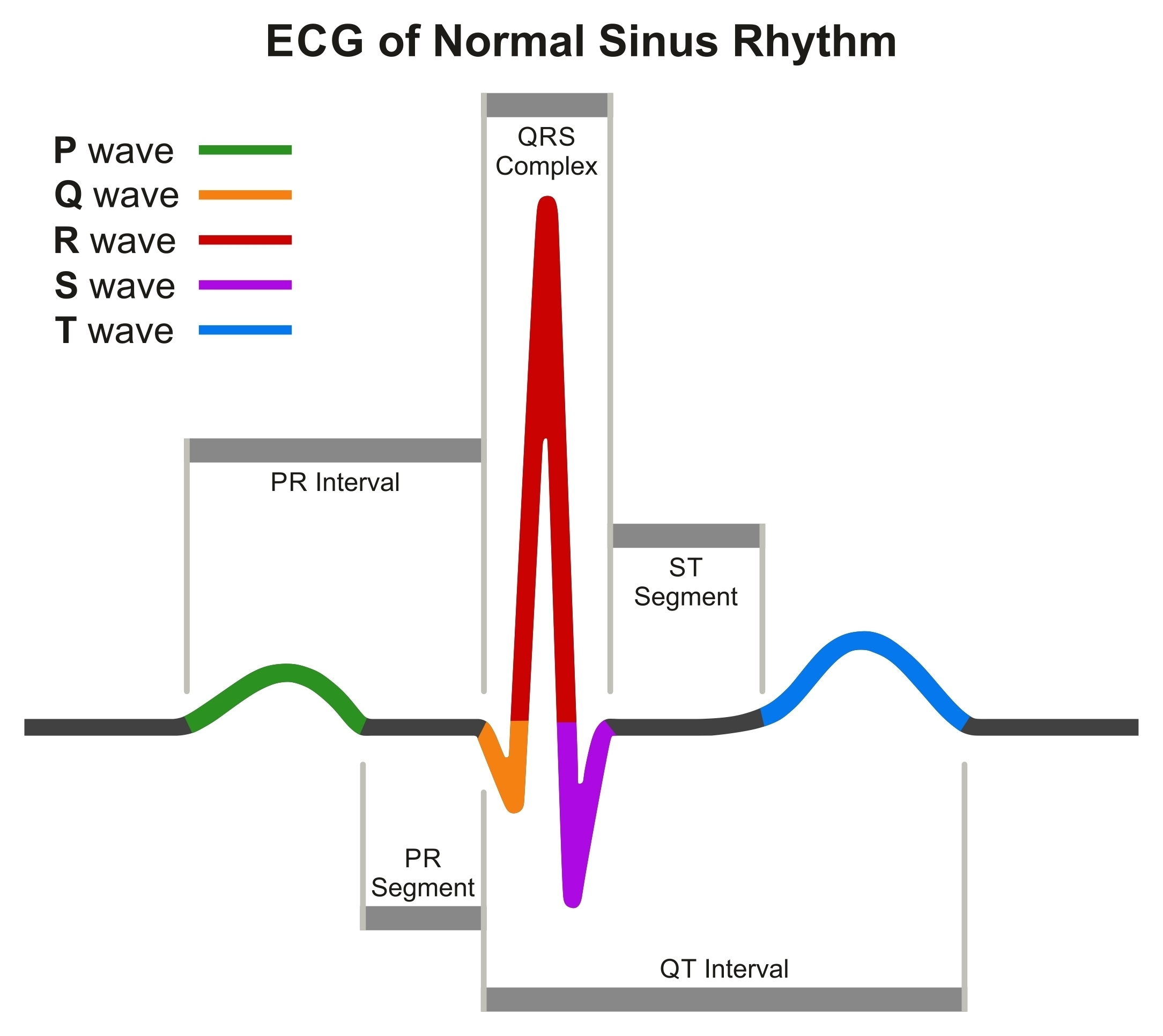 ECG (Electrocardiogram) tracing