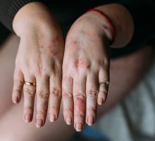 hand with eczema red patches on fingers