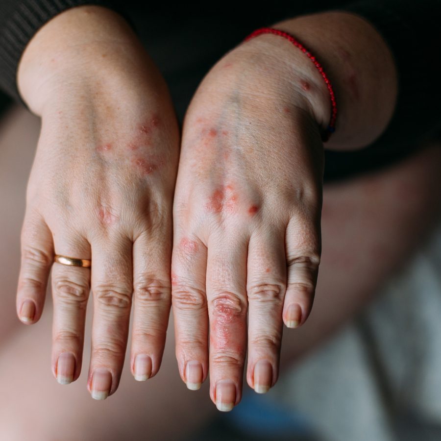 tirzepatide + glycine + b12 Lilly Says Compounded Tirzepatide With Added Vitamin B12 Contains  Impurities. Is It Safe?