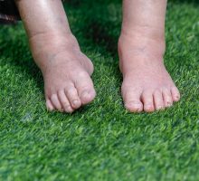 swollen ankles from amlodipine, bare feet on grass