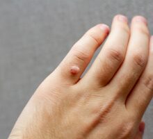wart on finger of left hand