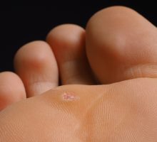 A plantar wart on the ball of the foot