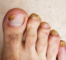 brown and yellow fungus on toenails