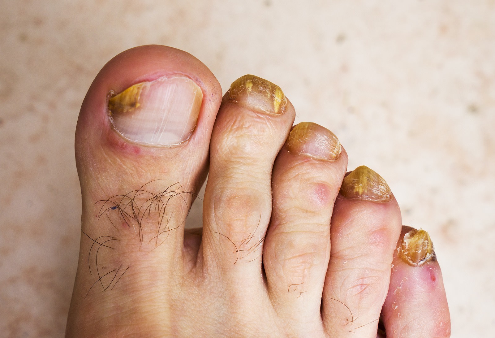 10. Accepting and Embracing Your Pinky Toenails: A Personal Perspective.