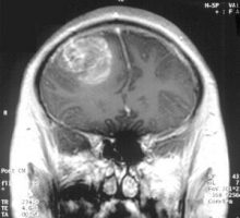 An MRI image of a glioblastoma brain tumor