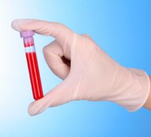 Blood test for Alzheimer disease