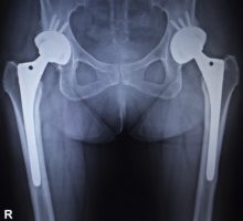 X ray showing a double Hip Replacement