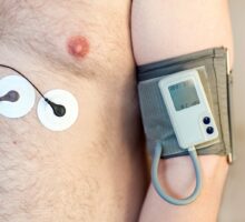 man wearing a Holter monitor to measure EKG and an ambulatory blood pressure monitor for 24 hour blood pressure readings.