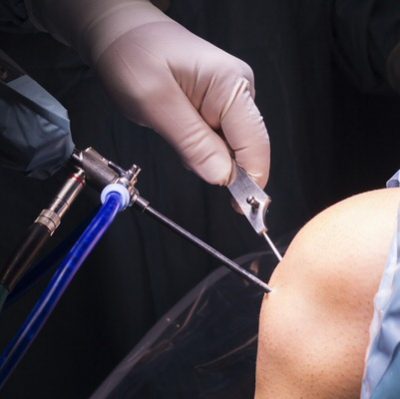 arthroscopic knee surgery