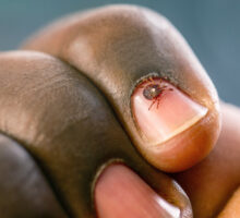 An adult female lone star tick crawling on a person's fingernail.