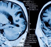 MRI scan of the head/brain