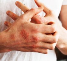 Two hands have psoriasis plaques on knuckles, left hand scratching right, can't afford Otezla
