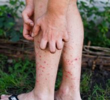 man scratching itchy bites on his legs