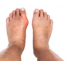 Swollen joint in left foot; man seeks to ease joint pain
