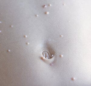 Molluscum Contagiosum