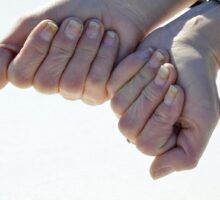 Onycholysis separated fingernails on both hands