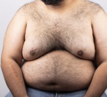 overweight man with gynecomastia-enlarged breasts