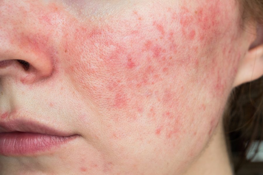tirzepatide rosacea Does IPL Work for Rosacea? Treatment Guide Rosacea Treatment in North Dallas