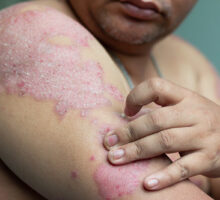 A person with psoriasis on his arm who can't afford Otezla