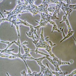 Microscope view of mens health Prostate Cancer cells in tissue culture showing walls nucleus and organelles