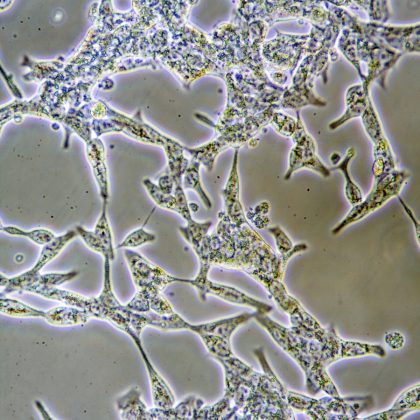 Microscope view of mens health Prostate Cancer cells in tissue culture showing walls nucleus and organelles