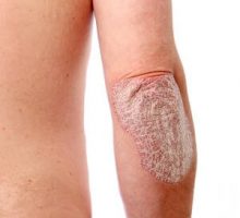 psoriasis plaque on an elbow