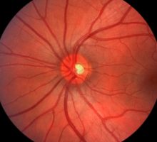 retina scan of healthy eye