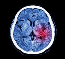 CT scan of brain show Ischemic Stroke or Hemorrhagic Stroke, bleeding in the brain