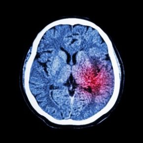 CT scan of brain show Ischemic Stroke or Hemorrhagic Stroke, bleeding in the brain, brain attack