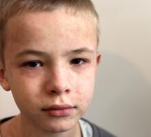 Sick sad boy with measles?