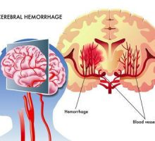 medical illustration of the effects of the cerebral hemorrhage