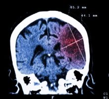 Cerebral infarction at left hemisphere ( Ischemic stroke ) ( CT-scan of brain )